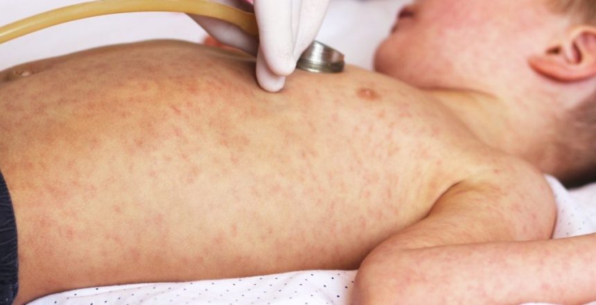 Second unvaccinated child dies of measles in Texas amid outbreak in the state
